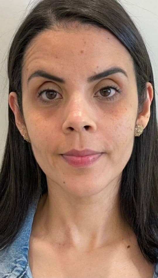 Antes do procedimento de Bioestimuladores de Colágeno