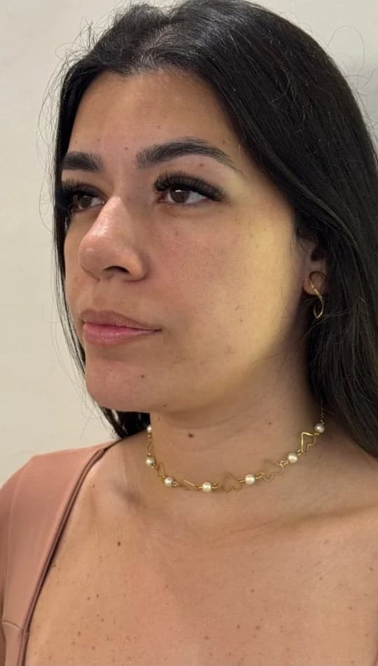 Antes do procedimento de Harmonização Facial