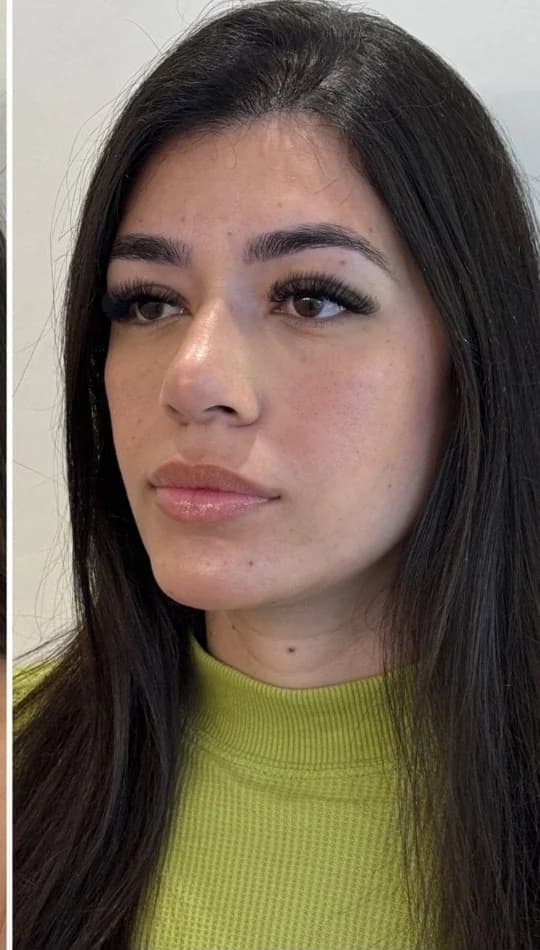 Depois do procedimento de Harmonização Facial