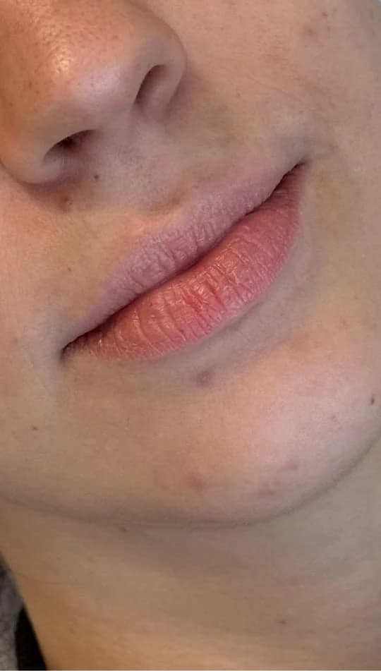 Antes do procedimento de Preenchimento Labial
