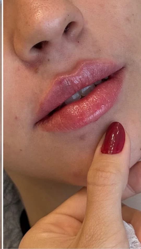 Depois do procedimento de Preenchimento Labial
