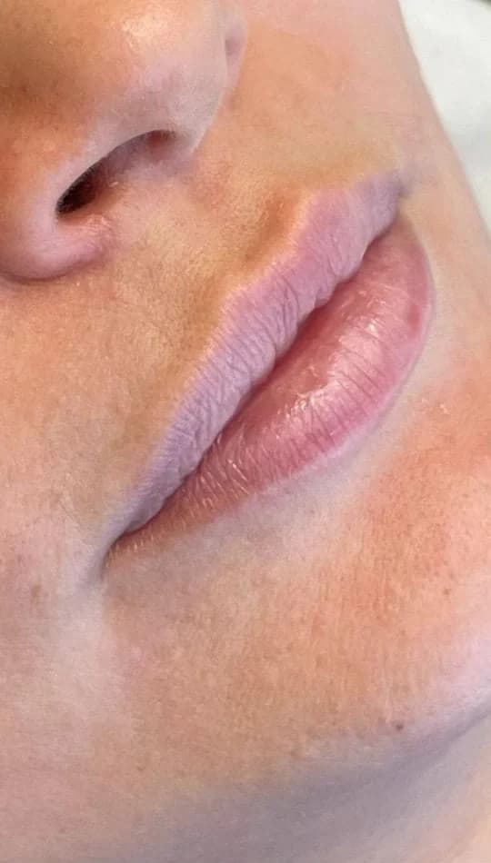 Antes do procedimento de Preenchimento Labial
