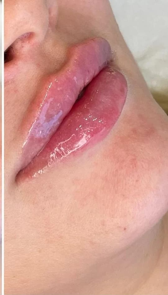 Depois do procedimento de Preenchimento Labial