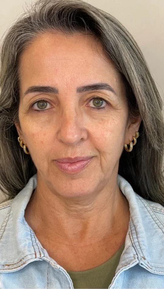 Antes do procedimento de ReFace 360®