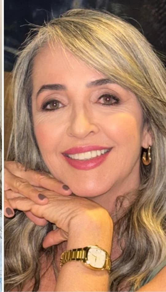 Depois do procedimento de ReFace 360®
