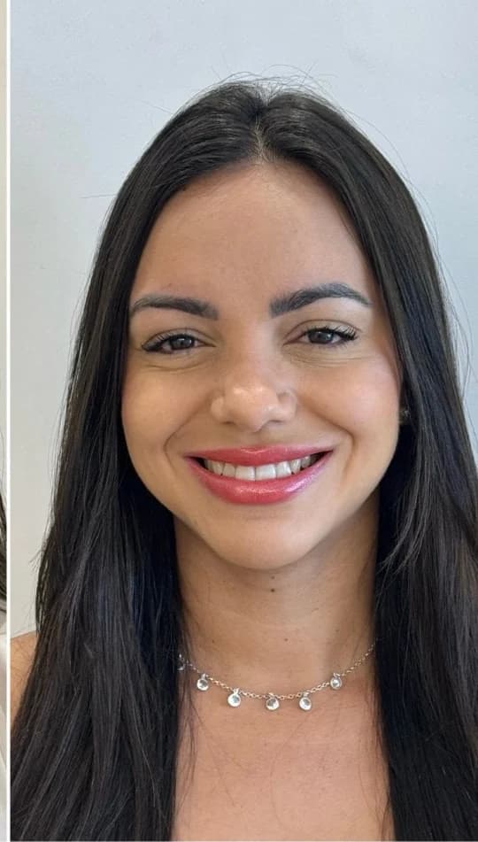 Depois do procedimento de Toxina Botulínica